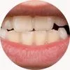 jaw botox treatment for Teeth grinding (bruxism)