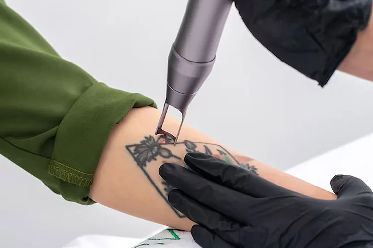 laser tattoo removal singapore