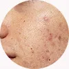 rejuran singapore price heal acne scar