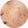 secret rf treatment for acne scars