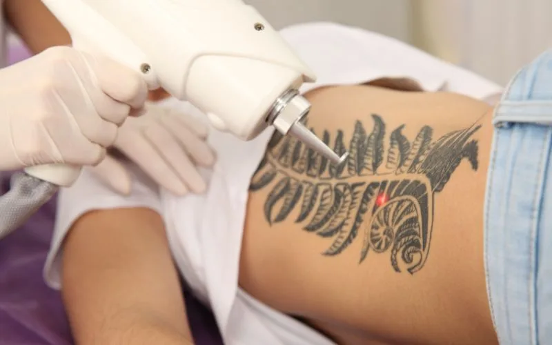 tattoo removal cost - Lasers don't remove your ink; your body does