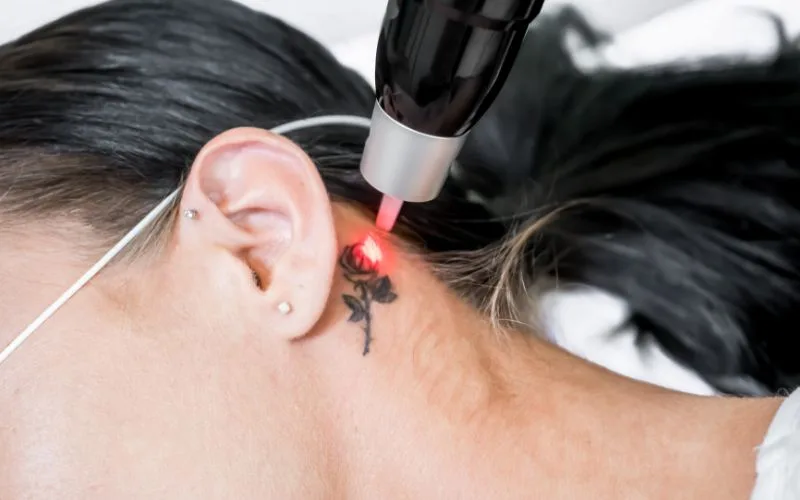 tattoo removal near me -The location of the tattoo matters
