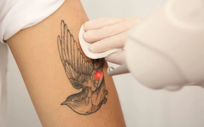 tattoo removal service - Tattoos differ greatly, and so does the removal