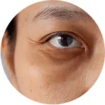 remove dark eye circle type of dark eye circle - Vascular