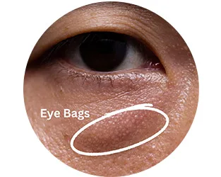 what is eye bag and how to remove